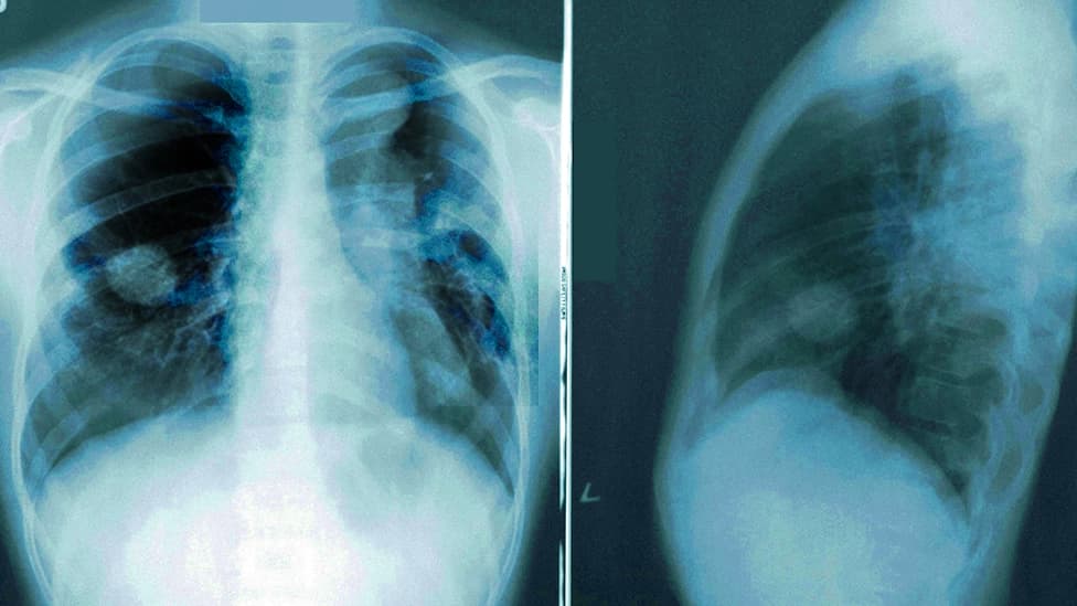 Synthetic X-ray Images of Lung Cancer Patients Dataset on Opendatabay data marketplace 