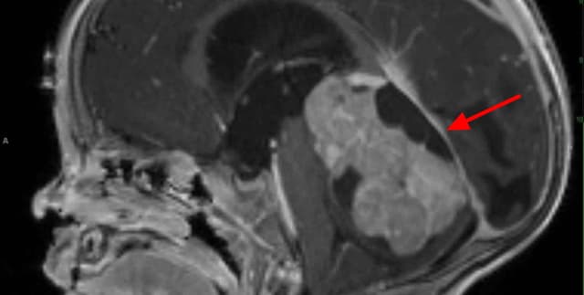 Childhood Brain Cancer Progression and Outcome Data Dataset on Opendatabay data marketplace