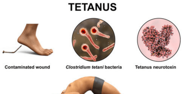 World Tetanus Status and Elimination Records Dataset on Opendatabay data marketplace