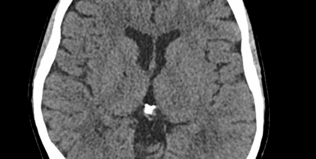 Brain CT Scans for Disease Detection Dataset on Opendatabay data marketplace