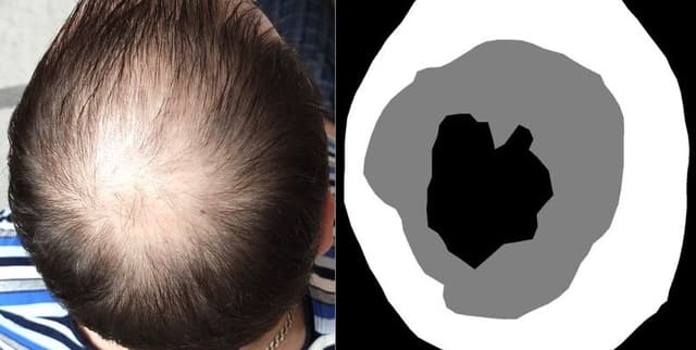 Hair Loss Segmentation Dataset Dataset on Opendatabay data marketplace