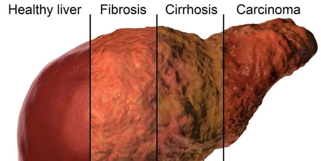 Cirrhosis Mortality Prediction Dataset Dataset on Opendatabay data marketplace