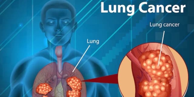 Predictive Factors for Lung Cancer Dataset on Opendatabay data marketplace