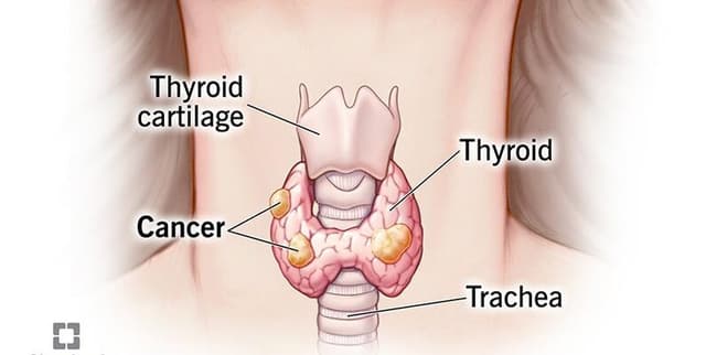 Thyroid Cancer Patient Risk Dataset Dataset on Opendatabay data marketplace
