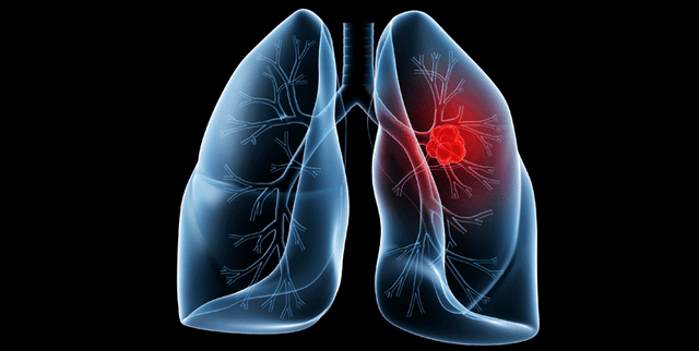Lung Cancer Risk Prediction Dataset Dataset on Opendatabay data marketplace
