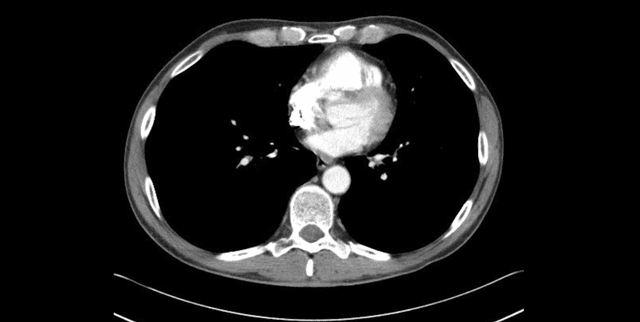 Iranian Hospital Lung Cancer Dataset Dataset on Opendatabay data marketplace
