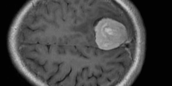 Brain Tumor MRI Diagnostics Dataset Dataset on Opendatabay data marketplace