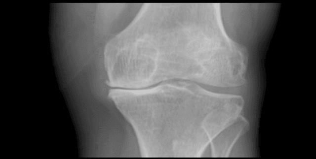 Digital Knee X-ray Images Dataset on Opendatabay data marketplace