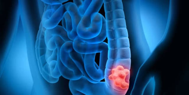 Historical Male Colon Cancer Mortality Data Dataset on Opendatabay data marketplace