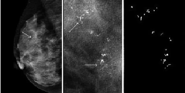 Imbalanced Breast Cancer Classification Data Dataset on Opendatabay data marketplace