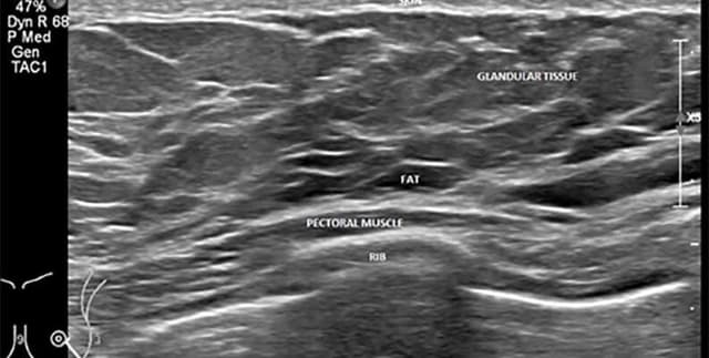 Breast Tumor Segmentation and Classification Dataset Dataset on Opendatabay data marketplace