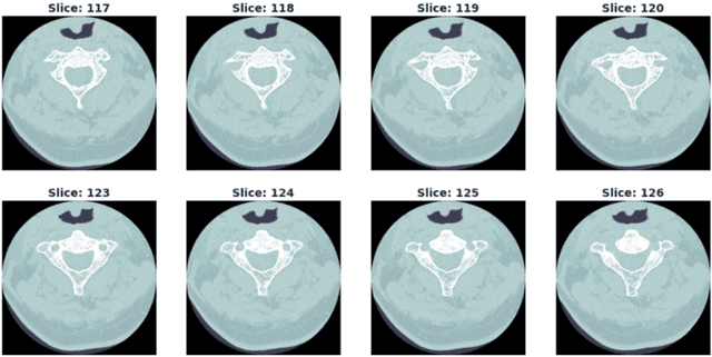 RSNA Cervical Spine Fracture Metadata Dataset on Opendatabay data marketplace