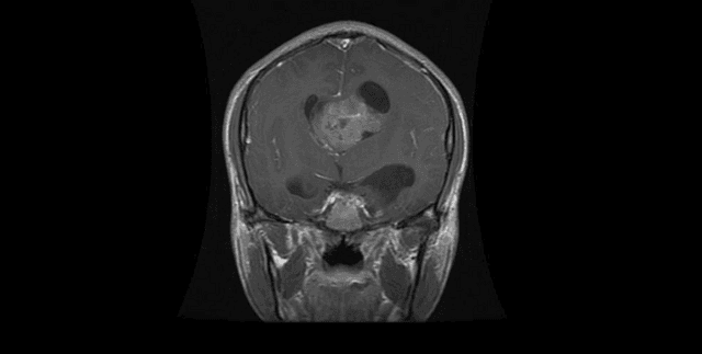 MRI Brain Tumour Classification Data Dataset on Opendatabay data marketplace