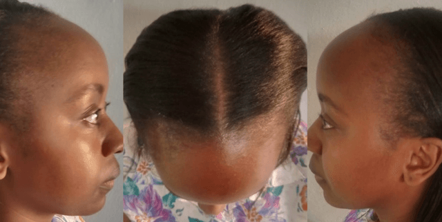 Female Hair Loss Detection Dataset Dataset on Opendatabay data marketplace