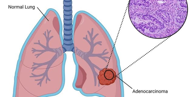 Raw Data Supporting Adenocarcinoma Prediction Dataset on Opendatabay data marketplace