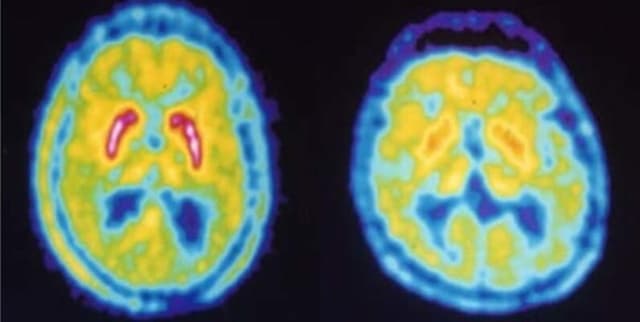 Parkinsons Disease Voice Screening Dataset on Opendatabay data marketplace