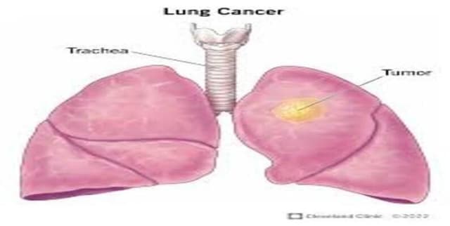 Lung Cancer Prediction Dataset Dataset on Opendatabay data marketplace
