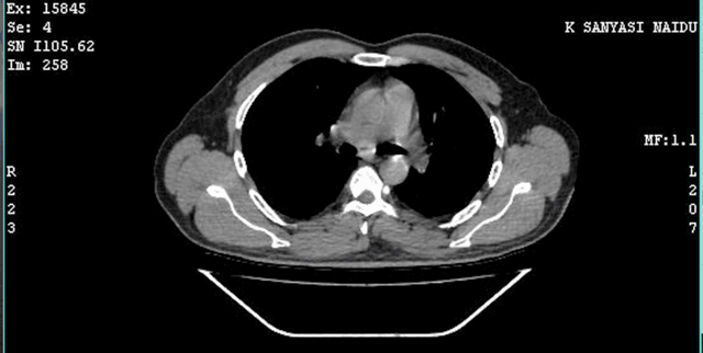 Cardiomegaly Chest-CT Analysis Data Dataset on Opendatabay data marketplace