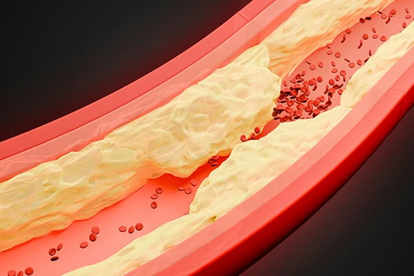 Synthetic Cardiovascular Disease Prediction Dataset Dataset on Opendatabay data marketplace